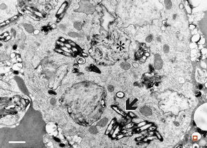 Whipple disease - duodenum Whipple disease - duodenum